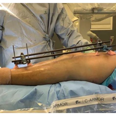 This Image Demonstrates A Modern External Fixator Applied For A Tibial