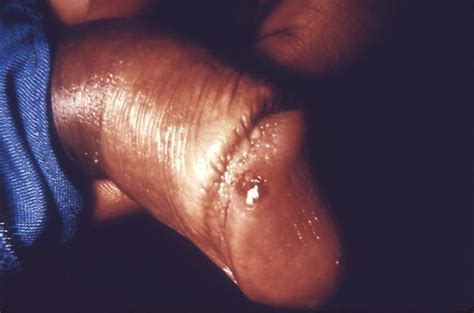 Painless Rash On Penis Tubezzz Porn Photos