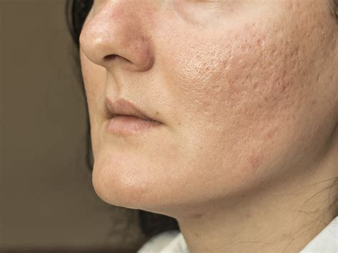 Say Goodbye To Spots Acne Scar Treatment And Removal In Sg