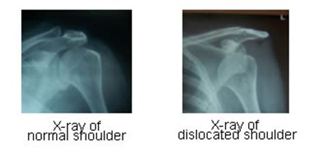 Recurrent Dislocation Of Shoulder JointSurgery In