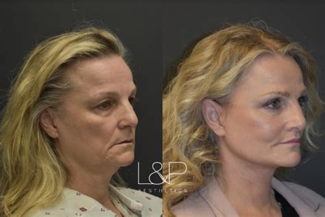 Facelift And Neck Lift Before And After Photos Case 35 Palo Alto And San