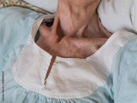 Very Skinny Old Woman Lying In A Bed Foto De Stock Adobe Stock