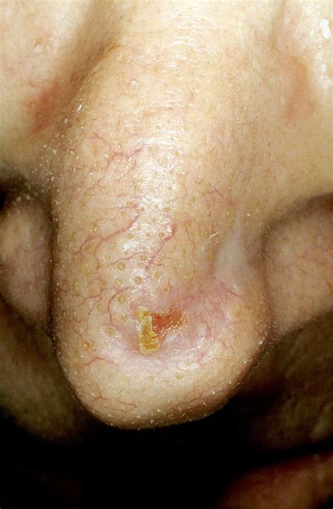 Skin Cancer On Nose Pictures 12 Photos And Images