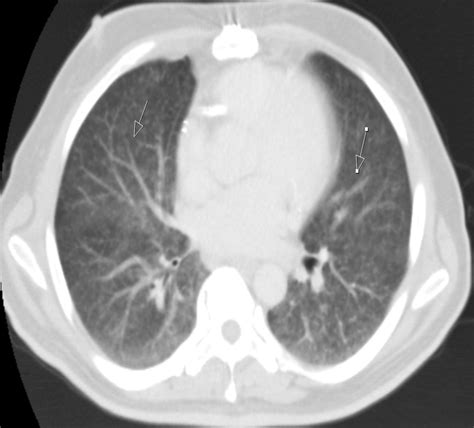 Cureus Systemic Manifestation Of Miliary Tuberculosis In Patient With