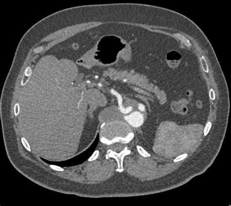 Aortic Dissection Vascular Case Studies Ctisus Ct Scanning