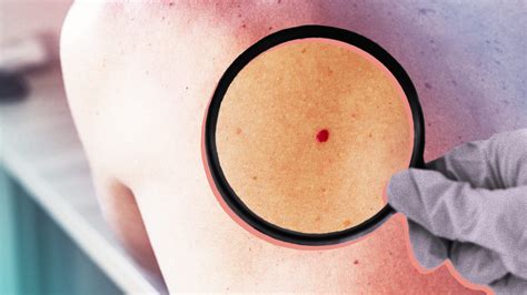 What Are Cherry Angiomas Symptoms Causes Treatments