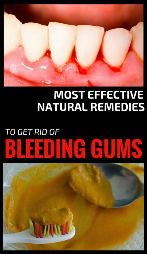 Gingivitis Is One Of The Most Common Dental Problems And The Good News