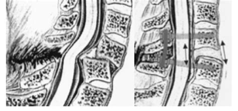 Drawings Depicting Cervical Injury With Traumatic Disc Herniation And