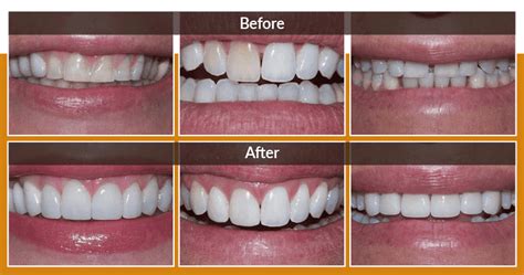 Porcelain Teeth Before And After