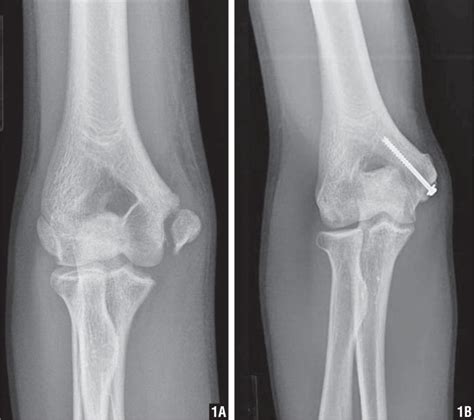 The ulnar branch (ramus ulnaris; Concurrent Little Leaguer's Elbow and Shoulder in a 15 ...