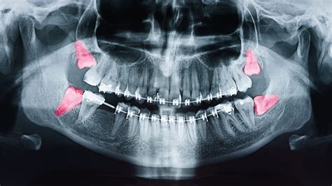 Wisdom Teeth Removal Why You Should Visit An Oral Surgeon Omsh