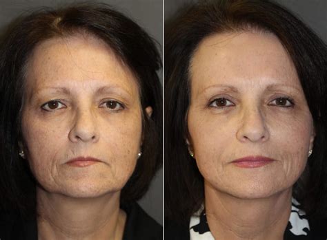 Patient 177928445 Facelift Before And After Photos Boston Center For