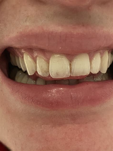 Why Are My Teeth Turning Transparent And How Can I Stop It Dentistry