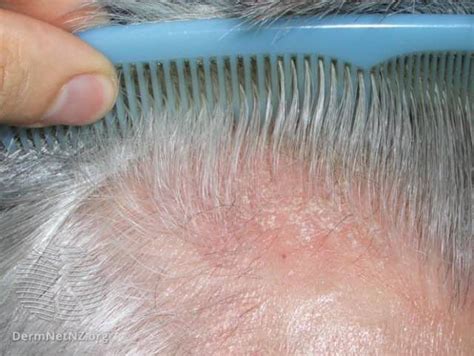 Dry Scalp Causes And Treatments