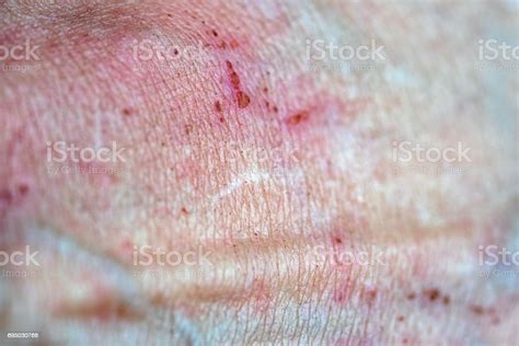 Bad Disease Skin Texture Close Up Stock Photo Download Image Now