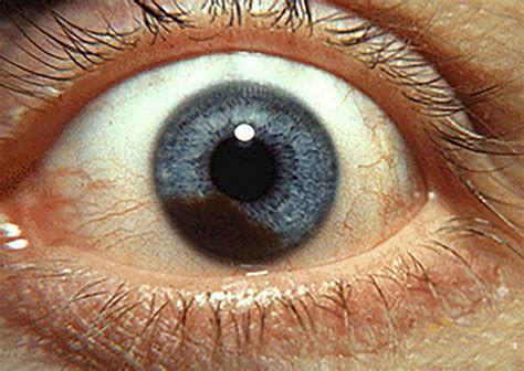 Eye Melanoma Symptoms Causes And Risk Factors