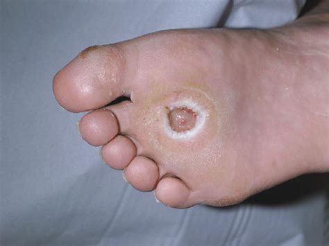Diabetic Foot Ulcers The Lancet