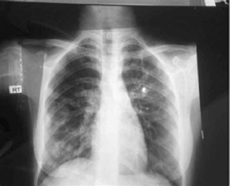 Tuberculosis X Ray Pdf Chest X Ray Patterns Of Pulmonary Multidrug Resistant Tuberculosis In