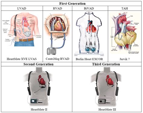 Bioengineering Free Full Text Cardiac Assist Devices Early