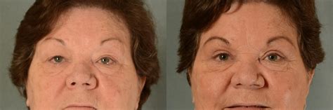 Eyelid Surgery Blepharoplasty Before And After Pictures Case 396