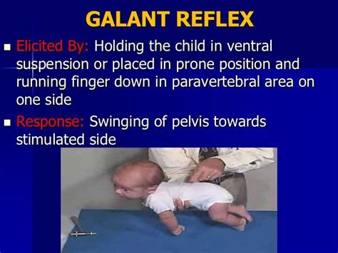 Galant Reflex Learning Disabilities Reflexes Obstetrics