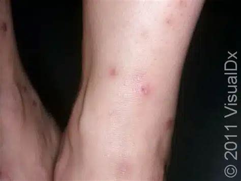 Flea Bite Condition Treatments And Pictures For Adults Skinsight