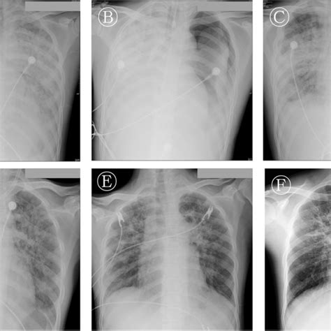 A Typical Serial Chest Radiographs Of Awake Ecmo Patients Patient 10