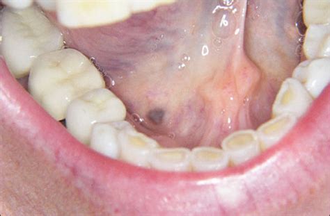 Lesions In Floor Of Mouth
