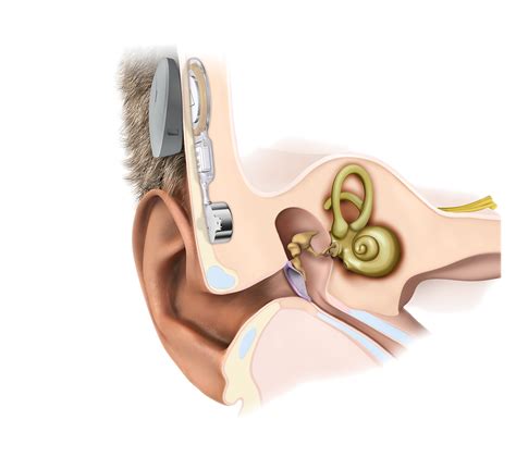 Bone Conduction Hearing Devices Hearing Link Services