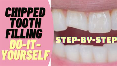 How To Fix A Chipped Tooth Filling Do It Yourself Dental Filling For