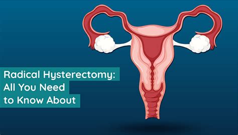 Radical Hysterectomy Overview Types Of Radical Hysterectomy Livlong