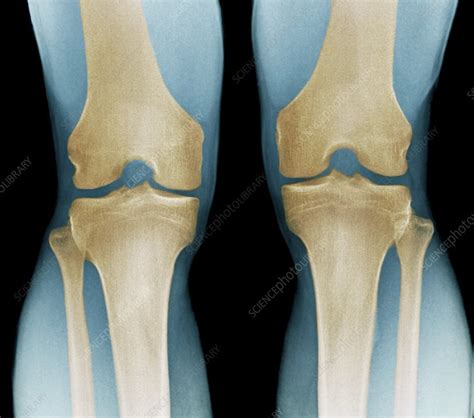 Normal Knees X Ray Stock Image F0033511 Science Photo Library