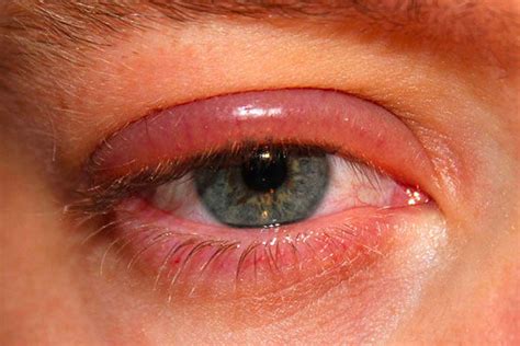 ¿qué Es La Blefaritis Causas Como Cuidar Los Ojos 👁