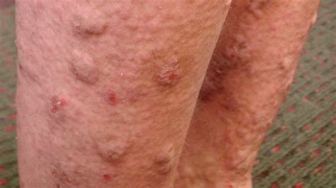 Liver Disease Skin Lesions