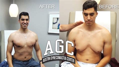 90 Minutes Of Gynecomastia Surgery Your Gyno Questions Answered Youtube
