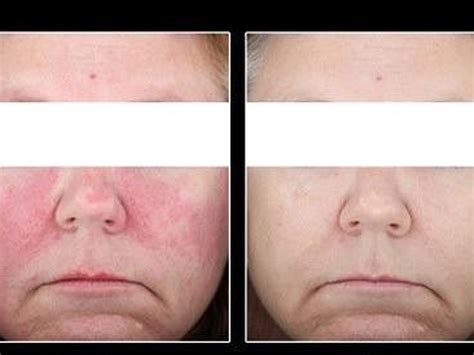 Rosacea And Facial Flushing North Wales Aesthetics