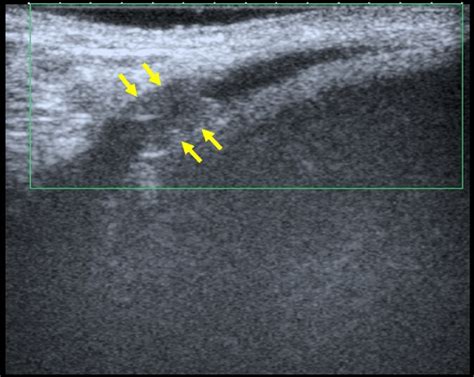 The Thrombosis In The Short Segment Of The Superficial Dorsal Penile