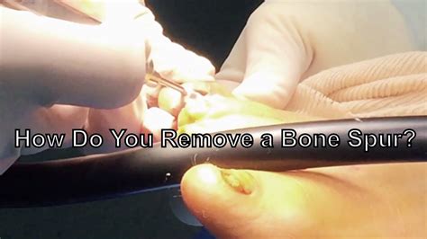 How To Remove A Bone Spur From The Toe Youtube
