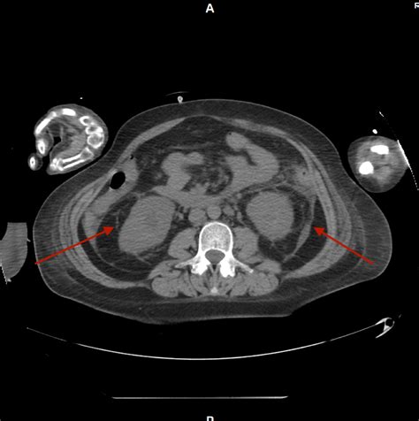 Cureus A Case Of Bilateral Infected Kidney Stones Presenting With