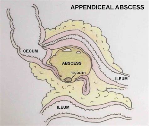 The Radiology Assistant Appendicitis Us Findings