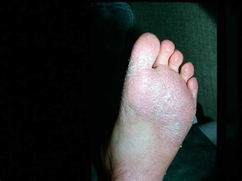 Juvenile Plantar Dermatosis Atopic Winter Feet Forefoot Dermatosis