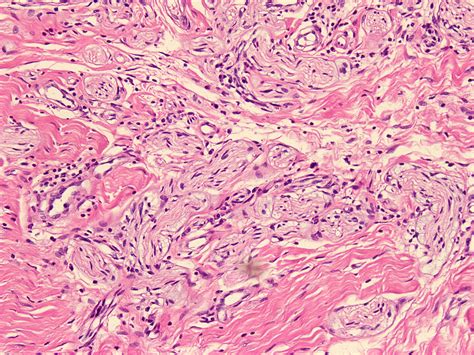 Pathology Outlines Neuroma