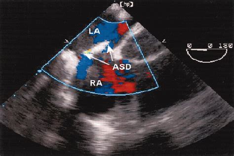 Transesophageal Echocardiography Circulation