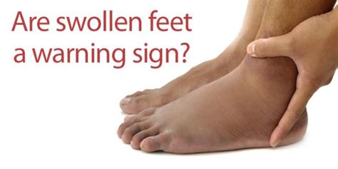 Footsmart Blog How Serious Are Swollen Feet Swollen Feet Swelling