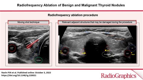 Radiofrequency Ablation Of Benign And Malignant Thyroid Nodules