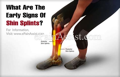 What Are The Early Signs Of Shin Splints