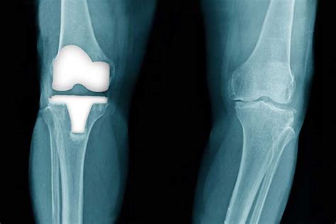 Knee Resurfacing Replacements For Patients In Pontefract