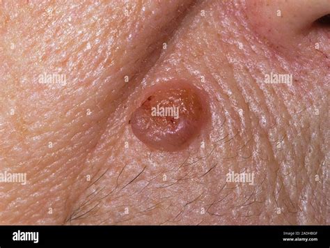 Skin Cancer Basal Cell Carcinoma Bcc Or Rodent Ulcer On The Face