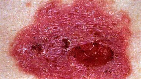 Basal Cell Carcinoma Skin Cancer Symptoms