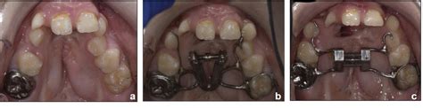 Orthodontic Treatments In Cleft Lip And Palate Patients Oral Health Group